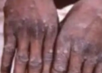 Guinée: un premier cas de variole du singe confirmé