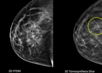 Octobre rose : mois symbolique de lutte contre le cancer de sein